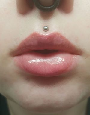 Titanium Internally Threaded Labret Customer Photo