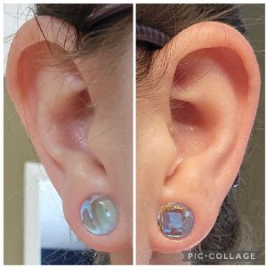 Polaris - Ear Lobe Repair