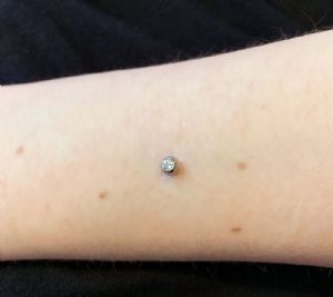 Internally Threaded Gem Microdermal End Customer Photo